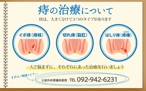 痔の治療について