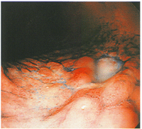 内視鏡でみた胃潰瘍