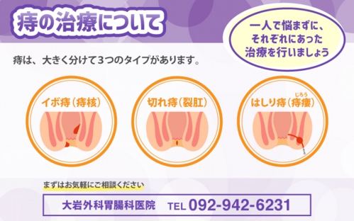 痔の治療について