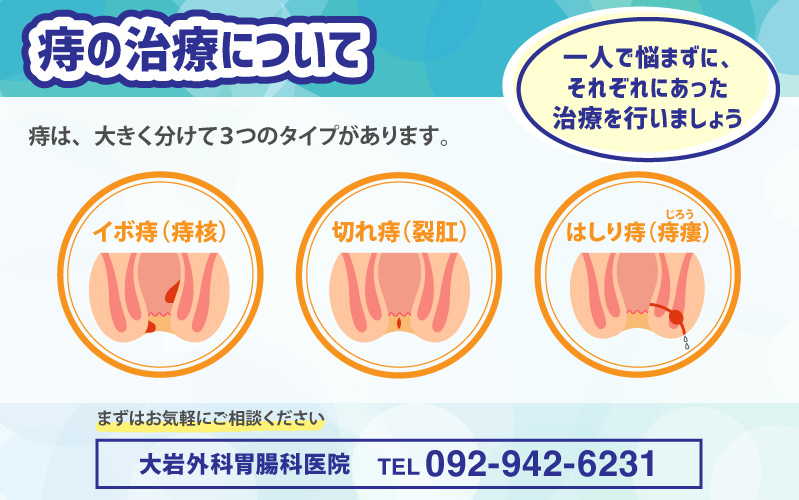痔の治療について