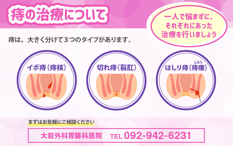 痔の治療について