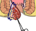 手術|痔の手術